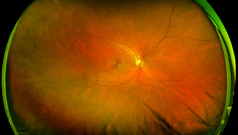 Ocular Disease Scan Photo